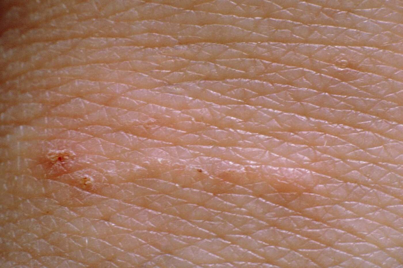 Understanding Scabies: Trends and Awareness in the UK