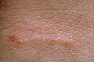 Understanding Scabies: Trends and Awareness in the UK