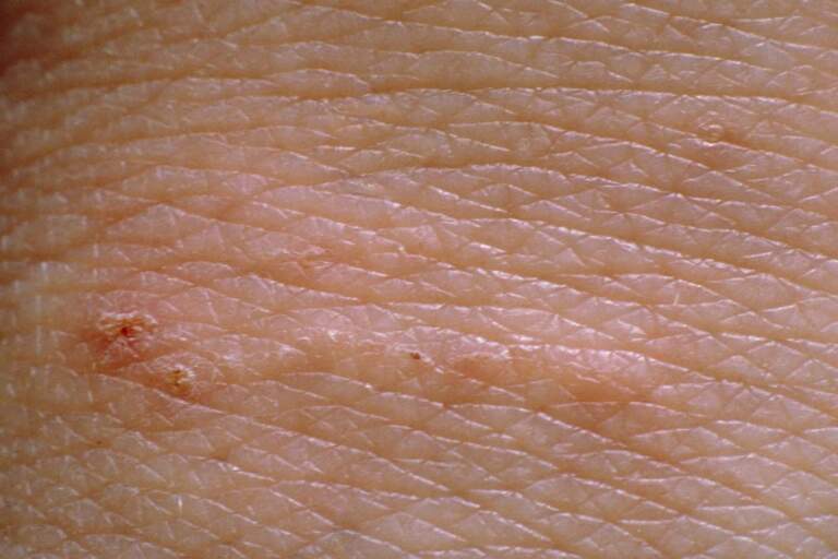 Understanding Scabies: Trends and Awareness in the UK