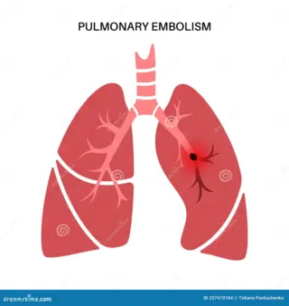 Understanding Pulmonary Embolism: Symptoms, Risks, and Treatments