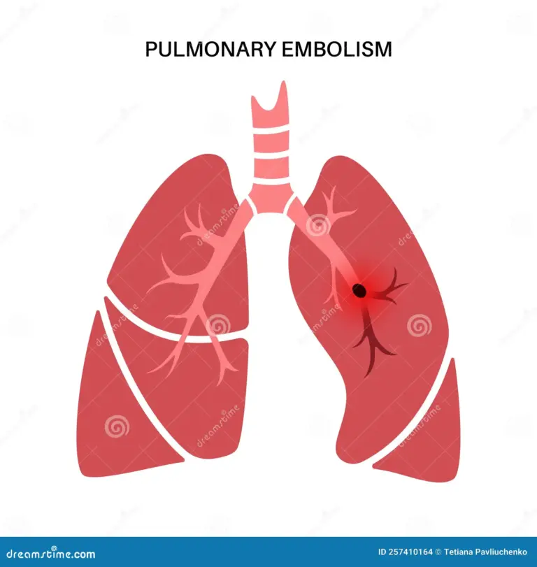 Understanding Pulmonary Embolism: Symptoms, Risks, and Treatments