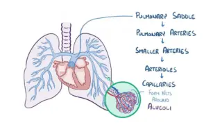 Understanding Pulmonary Embolism and Its Impact on Health